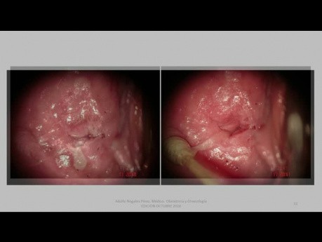 Traitement du condylome de la vulve NIV 2