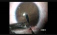 une lentille intraoculaire secondaire (LIO),  la lensectomie par la pars plana.