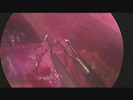 Mini-bypass gastrique après une gastrectomie en manchon