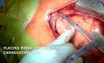 Remplacement de la valve aortique et mitrale par sternotomie