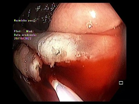 Couple Mucosectomie/Dissection Sous-Muqueuse Endoscopique dans le Colon Ascendant