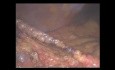Infarctus Idiopathique du Grand Epiploon