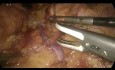 Surrénalectomie Gauche - Technique Laparoscopique