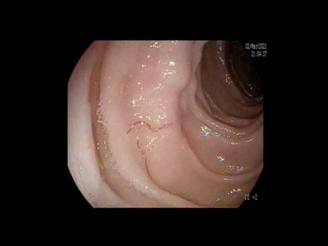  Ver parasite accroché à la paroi intestinale et provoquant une hémorragie