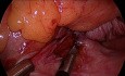 suspension des ligaments utéro-sacrés - vNOTES