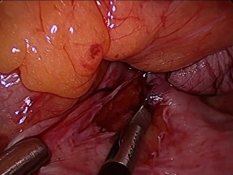 suspension des ligaments utéro-sacrés - vNOTES