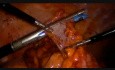 Hémicolectomie droite laparoscopique par voie transvaginale