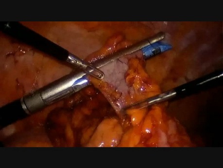 Hémicolectomie droite laparoscopique par voie transvaginale