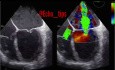 Visualisation par Echocardiographie trans-oesophagienne (ETO) d'une incompétence sévère de la valve mitrale : Feuillets mal adaptés et jet central