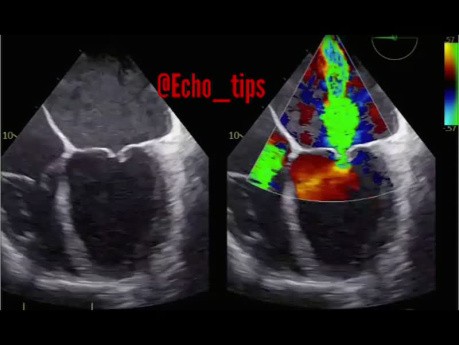 Visualisation par Echocardiographie trans-oesophagienne (ETO) d'une incompétence sévère de la valve mitrale : Feuillets mal adaptés et jet central