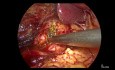 Cholédochotomie Laparoscopique et Drainage d'un Abcès Hépatique