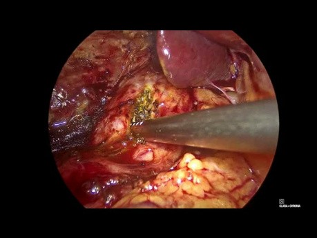 Cholédochotomie Laparoscopique et Drainage d'un Abcès Hépatique