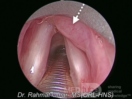 Lymphome du Larynx