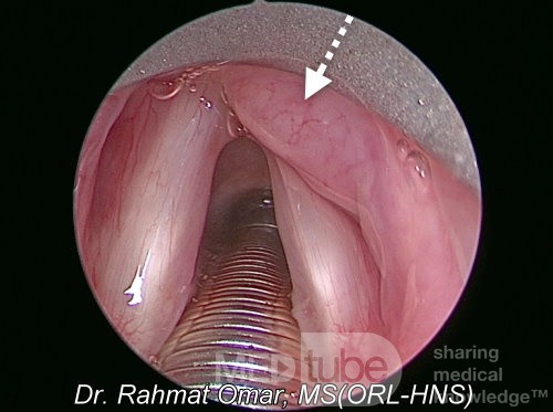 Lymphome du Larynx