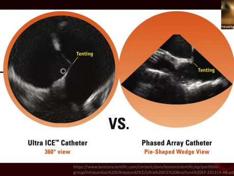 Une Introduction à l'Echocardiographie Intracardiaque 