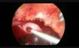 Salpingectomie laparoscopique due à une GEU avec hémopéritoine