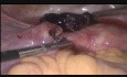 Grossesse ectopique - la salpingostomie et la fimbrioplastie 