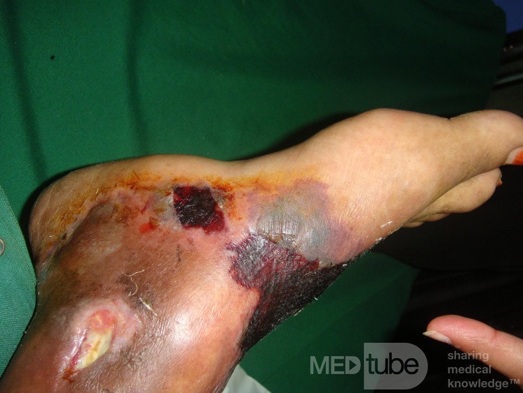 Le pied diabétique - une blessure après un bandage trop serré. 3