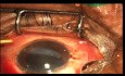 Retrait de corps étrangers intraoculaires multiples avec récupération visuelle réussie