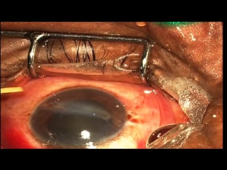 Retrait de corps étrangers intraoculaires multiples avec récupération visuelle réussie