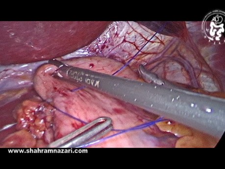 Modification en Trois Points de la Fundoplicature de Dor