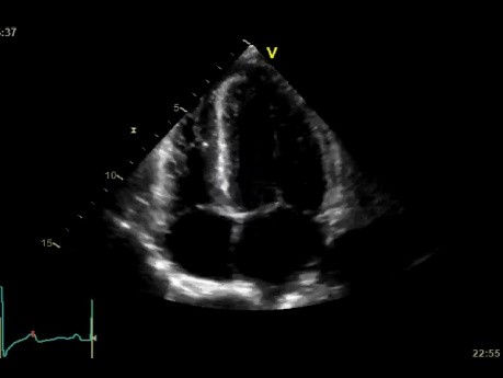 une cardiopathie d'origine hypertensive