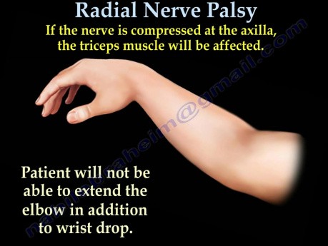Paralysie du nerf radial - Paralysie du samedi soir - Partie 1