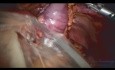 Gastrectomie Quasi-Totale Robotisée 