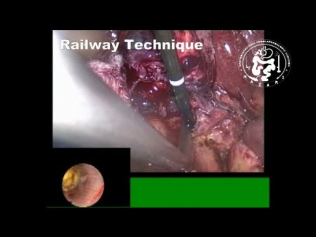 Exploration Laparoscopique du Cholédoque - Extraction de Calculs du Canal Hépatique Droit