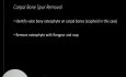 Rupture du Tendon du Muscle Long Fléchisseur du Pouce (Syndrome de Mannerfelt) - Evaluation et Prise en Charge Chirurgicale