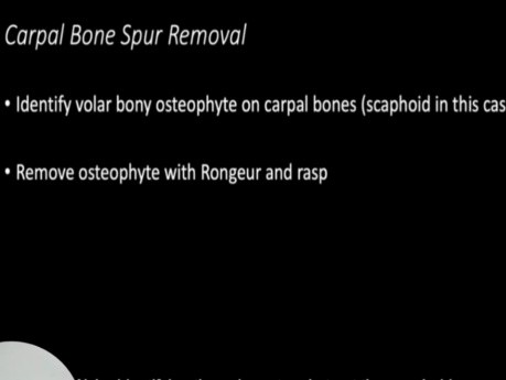 Rupture du Tendon du Muscle Long Fléchisseur du Pouce (Syndrome de Mannerfelt) - Evaluation et Prise en Charge Chirurgicale