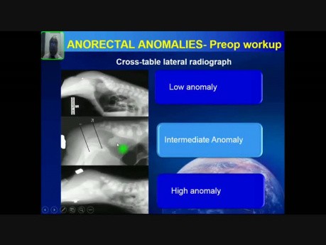 Malformations anorectales