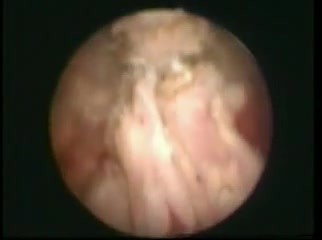 Résection Trans-Urétérale de Prostate - RTUP