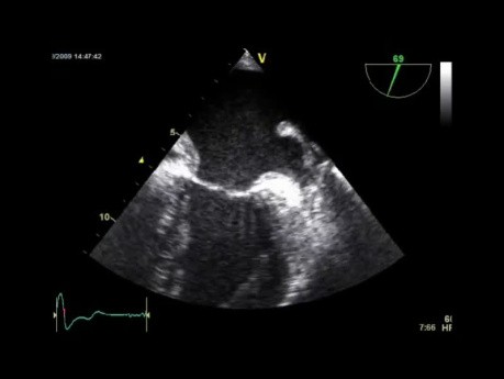 Quiz de l'échocardiographie transoesophagienne (résultat anormal) et une révision de certaines image de base