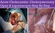 Cholécystite Aiguë et Cholécystectomie – Ouverte et Laparoscopique
