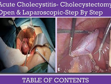 Cholécystite Aiguë et Cholécystectomie – Ouverte et Laparoscopique