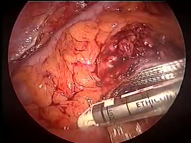 Amputation abdomino-périnéale par laparoscopie