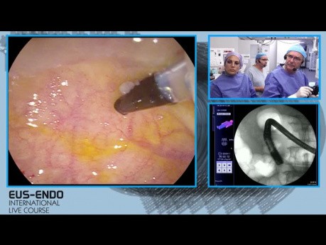 La cholangiopancréatographie rétrograde endoscopique (CPRE) - extraction du calcul de la voie biliaire principale.