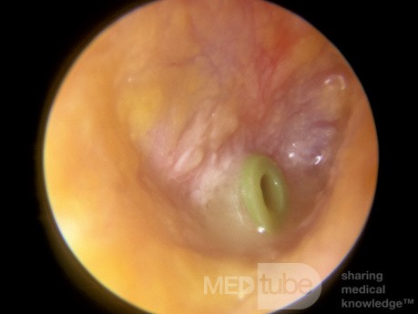 Otite moyenne aiguë avec un tube de ventilation en place