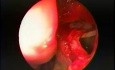 Antrostomie maxillaire par voie trans-nasale - endoscopie