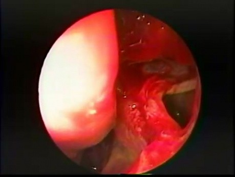 Antrostomie maxillaire par voie trans-nasale - endoscopie