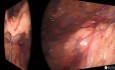 Sigmoïdectomie Laparoscopique Avec Fluorescence - Cas de Cancer Colorectal Avancé (T3N2)