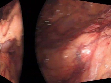 Sigmoïdectomie Laparoscopique Avec Fluorescence - Cas de Cancer Colorectal Avancé (T3N2)
