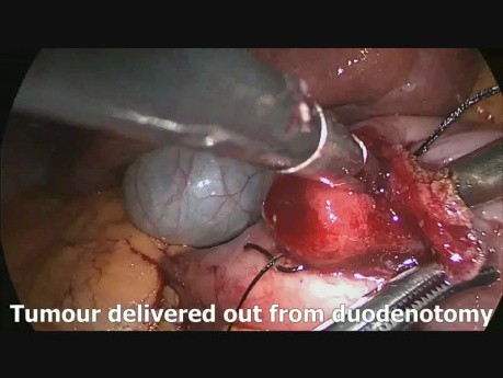 Résection d'une tumeur neuro-endocrine du duodénum par voie laparoscopique transduodénale 