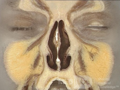 Anatomie coronale du nez et des sinus paranasaux: tranche 3