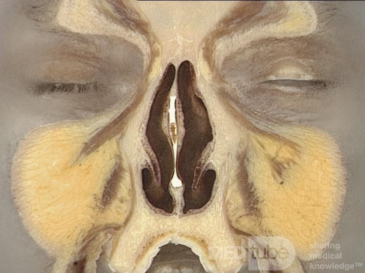 Anatomie coronale du nez et des sinus paranasaux: tranche 3