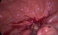 Nécrosectomie trans-gastrique par coelioscopie