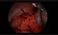 Torsion d'annexe avec un kyste - intervention laparoscopique