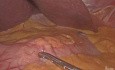 Gastrectomie partielle par laparoscopie avec un curage ganglionnaire de type D1 