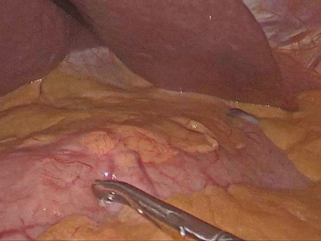 Gastrectomie partielle par laparoscopie avec un curage ganglionnaire de type D1 